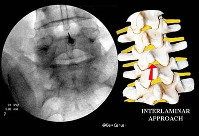 Herniated Disc or Sciatica | Lumbar Disc Herniation Interlaminar