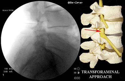 Herniated Disc or Sciatica | Lumber Disc Herniation Transforaminal