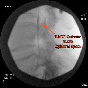 Racz Catheter Epidural