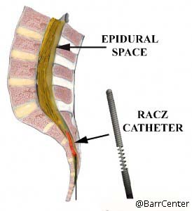 Racz Catheter