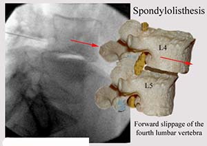 Arthritis of the Lumbar Spine