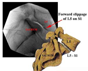 Arthritis of the Lumbar Spine