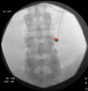 Facet Joint Injection Causes