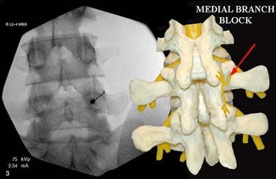 Facet Joint Injection | Barr Center