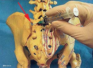 Sacroriliac Joint Injection | Barr Center
