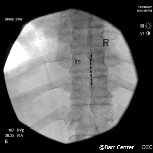 Spinal Cord Stimulation