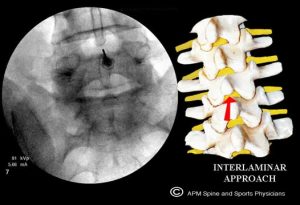Epidural Steroid Injections | Interlaminar ESI Approach | Barr Center