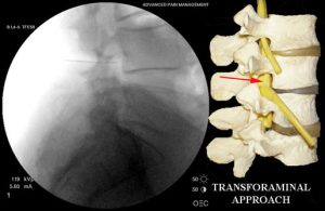 Epidural Steroid Injections } Transforaminal ESI or Retro-Discal ESI | Barr Center