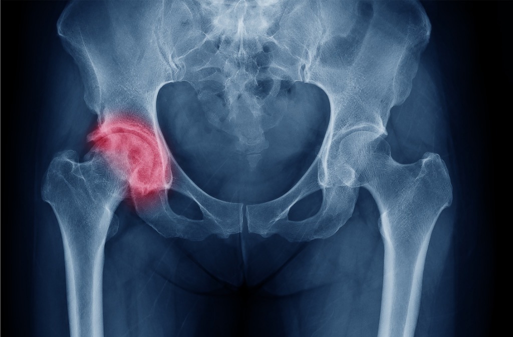 X-ray showing degenerative joint changes