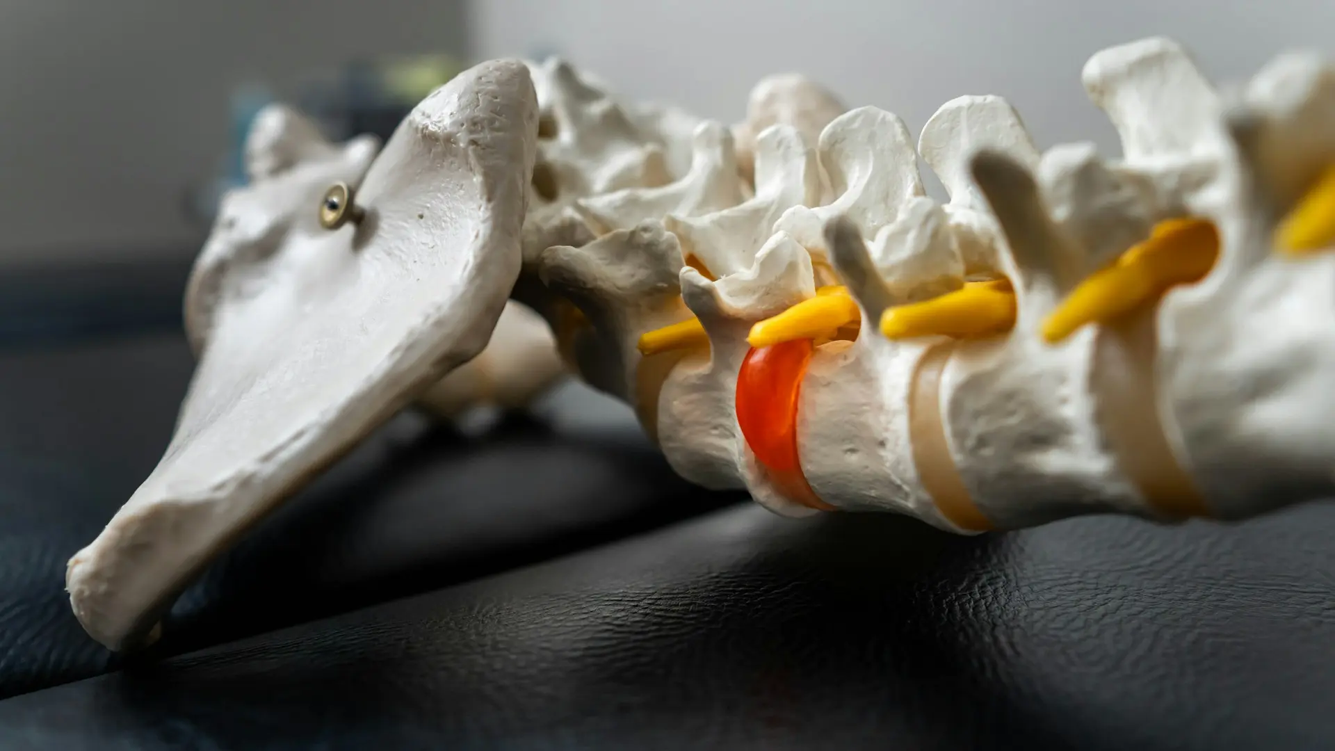 Anatomical spine model highlighting a compressed spinal nerve root between vertebrae.