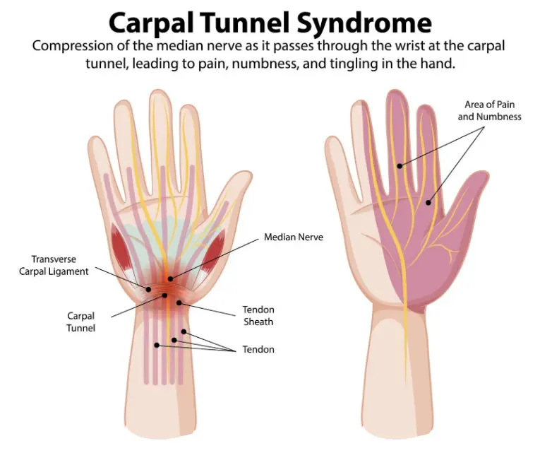 Medical illustration labeled Carpal Tunnel Syndrome showing the median nerve passing through the wrist at the carpal tunnel. Labels identify structures such as the transverse carpal ligament and tendons, while a second hand diagram highlights areas of pain and numbness in the fingers and palm.
