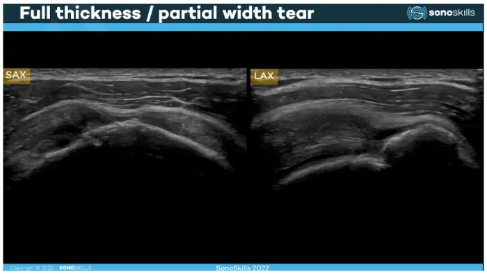 Two ultrasound images labeled SAX and LAX under the title “Full thickness / partial width tear.” The scans show the shoulder tendon with an irregular gap indicating a rotator cuff tear. The images demonstrate how the tear appears in both short-axis and long-axis ultrasound views.