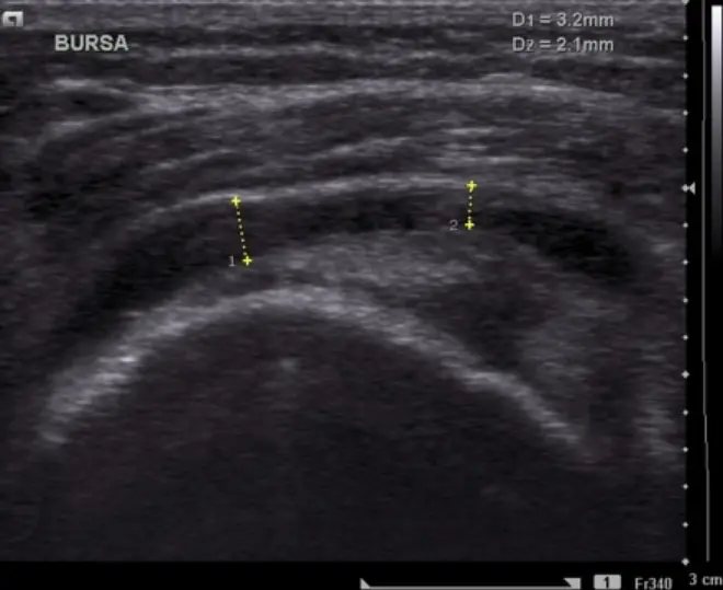 Ultrasound image labeled Bursa showing a cross-section of the hip region. A curved bright structure represents the greater trochanter of the femur, with a darker fluid-filled space above it indicating the bursa. Two measurement markers are shown with labels D1 = 3.2 mm and D2 = 2.1 mm, indicating the measured thickness of the bursa.