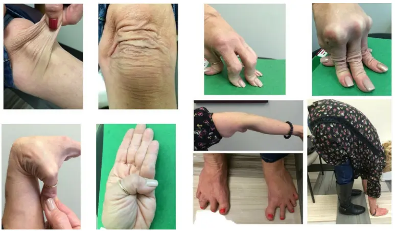 Collage of photos showing joint hypermobility, including very stretchy skin, fingers bending far back, elbows and knees extending beyond normal range, wide-spreading toes, and a person bending forward with palms on the floor.