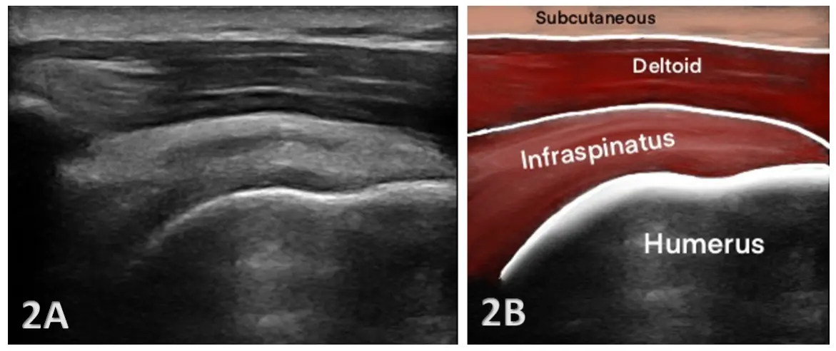 Side-by-side images of a shoulder ultrasound. The left image (2A) shows a grayscale ultrasound scan with layered soft tissues above the curved surface of the humerus bone. The right image (2B) shows the same anatomy with color overlays and labels identifying the subcutaneous layer, deltoid muscle, infraspinatus muscle, and the humerus bone below.
