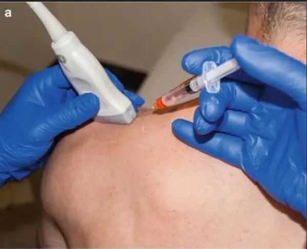 Clinician performing an ultrasound-guided injection into the shoulder area to treat a myofascial trigger point.