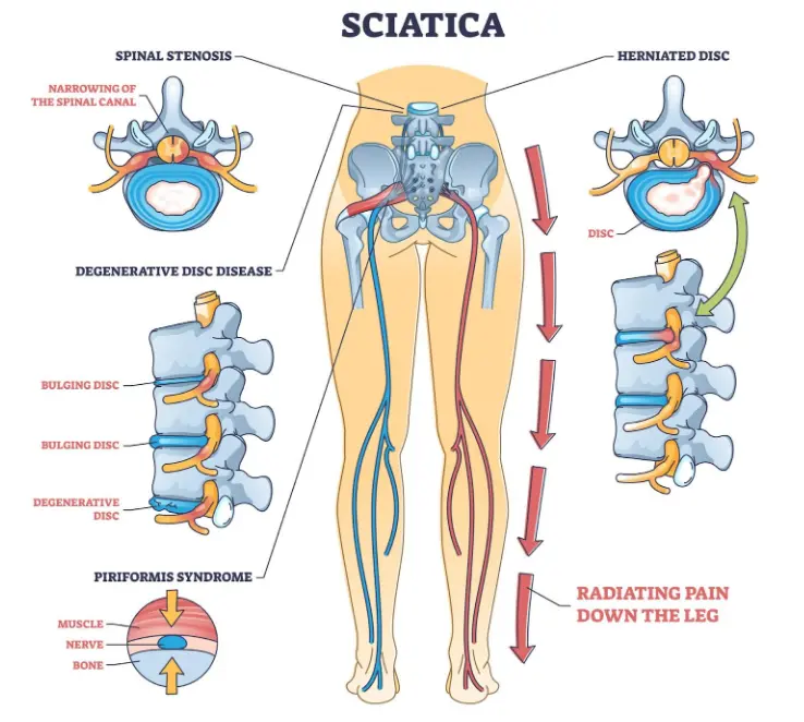 Medical illustration labeled “Sciatica” showing the sciatic nerve running from the lower spine through the hips and down the legs. Additional diagrams illustrate causes such as spinal stenosis, herniated disc, degenerative disc disease, and piriformis syndrome. Arrows indicate radiating pain traveling from the lower back down the leg.
