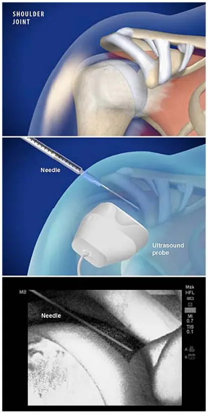 Three-panel illustration showing a shoulder joint and an ultrasound-guided injection. The top panel displays the shoulder joint anatomy with the humeral head and surrounding structures. The middle panel shows a needle entering the shoulder while an ultrasound probe is placed on the skin to guide the injection. The bottom panel presents the ultrasound image where the needle is visible approaching the joint.