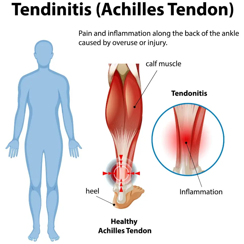 Medical illustration labeled Tendinitis (Achilles Tendon) showing the calf muscle and Achilles tendon connecting to the heel. Red highlighting indicates inflammation along the back of the ankle, with arrows pointing to the painful area near the heel.