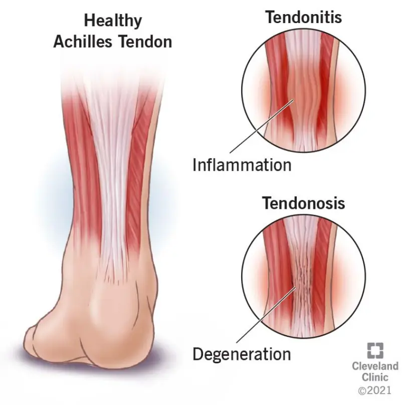 Illustration comparing a healthy Achilles tendon with two conditions: tendinitis and tendinosis. The healthy tendon appears smooth, while the tendinitis image highlights inflammation and redness. The tendinosis image shows degeneration and structural changes within the tendon fibers.