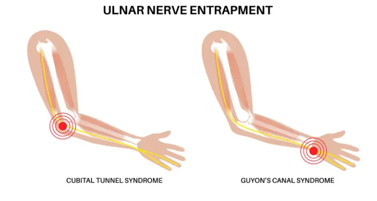 Diagram labeled Ulnar Nerve Entrapment showing the path of the ulnar nerve through the arm. Two examples highlight compression points at the elbow (cubital tunnel syndrome) and at the wrist (Guyon's canal syndrome).