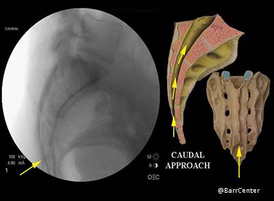 Herniated Disc or Sciatica | Lumbar Disc Herniation Caudal