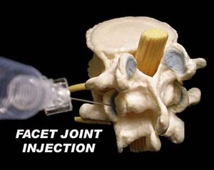 Facet Joint Injections | Barr Center