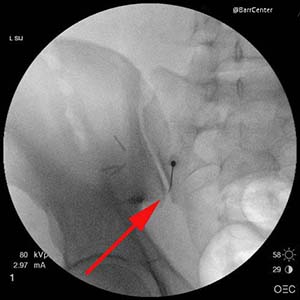 Sacroiliac Joint Injection