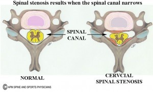 Spinal Stenosis | Barr Center
