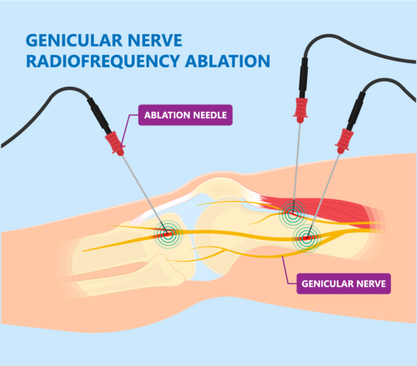 Genicular Nerve Block for Chronic Knee Pain Barr Center