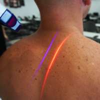 cold laser therapy for pain