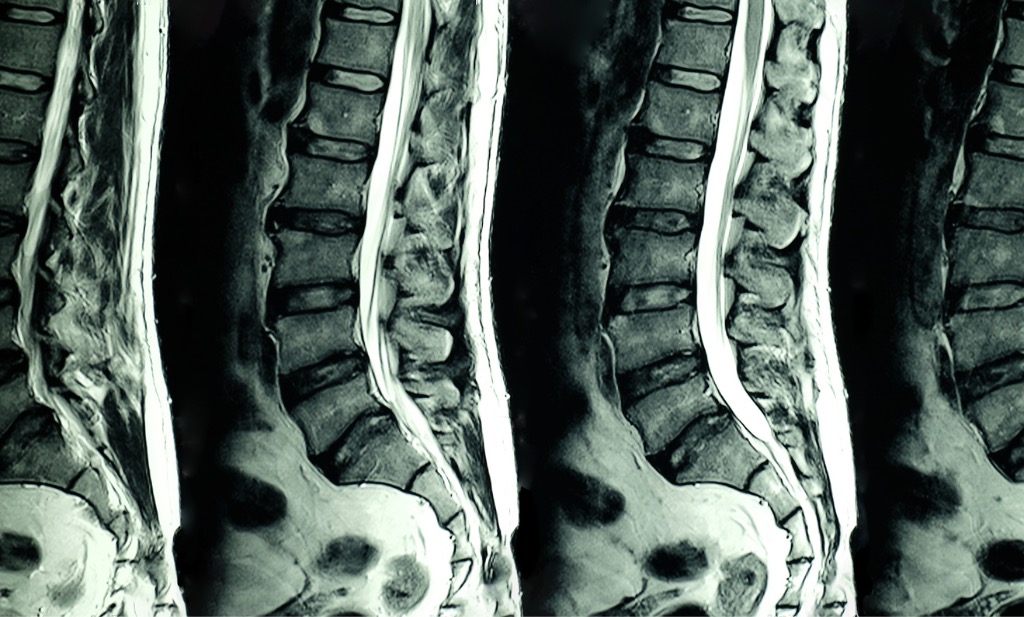 MRI scan of lumbar spines
