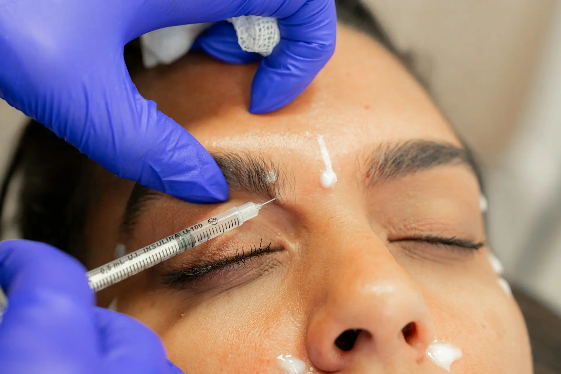 Cosmetic or therapeutic injection administered near the eyebrow/forehead area.