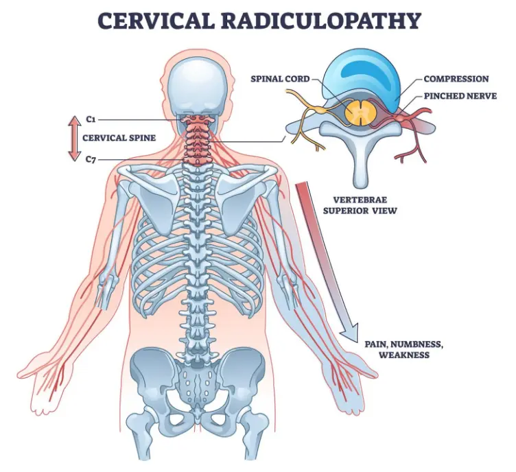 Medical diagram labeled “Cervical Radiculopathy” showing the cervical spine (C1-C7) and nerves extending from the neck into the shoulders and arms. An inset cross-section of a vertebra shows a compressed or pinched nerve near the spinal cord. Arrows highlight symptoms such as pain, numbness, and weakness radiating into the arm.