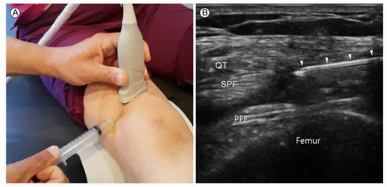 Two-panel image showing an ultrasound-guided knee injection. In panel A, a clinician places an ultrasound probe on a patient's knee while inserting a syringe into the joint area. Panel B shows the ultrasound view with labeled structures including the quadriceps tendon (QT), suprapatellar fat pad (SPF), prefemoral fat pad (PFF), and femur. Arrowheads indicate the needle as it enters the knee region under ultrasound guidance.