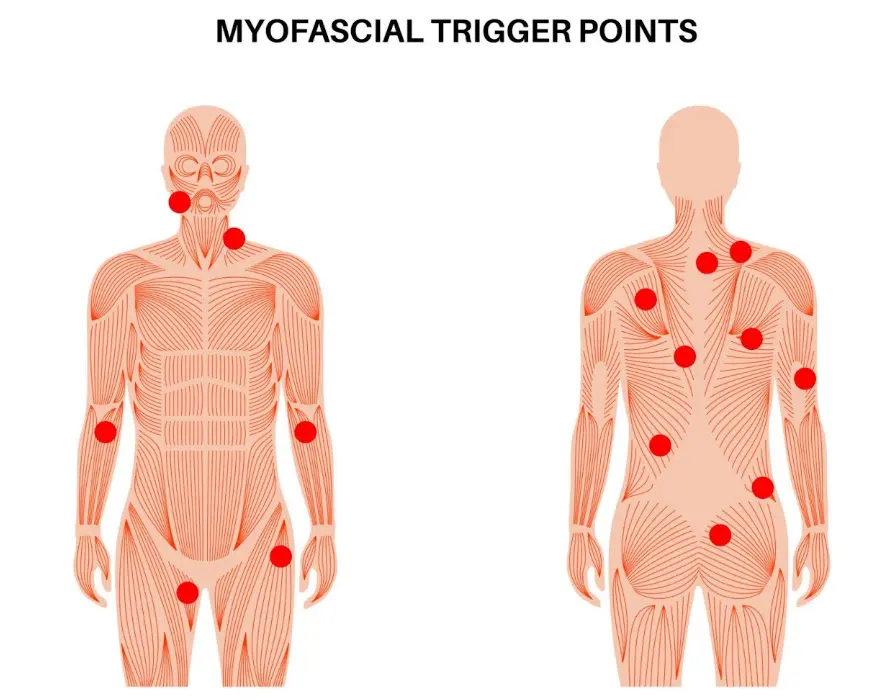 Diagram showing common myofascial trigger point locations on the front and back of the human body.