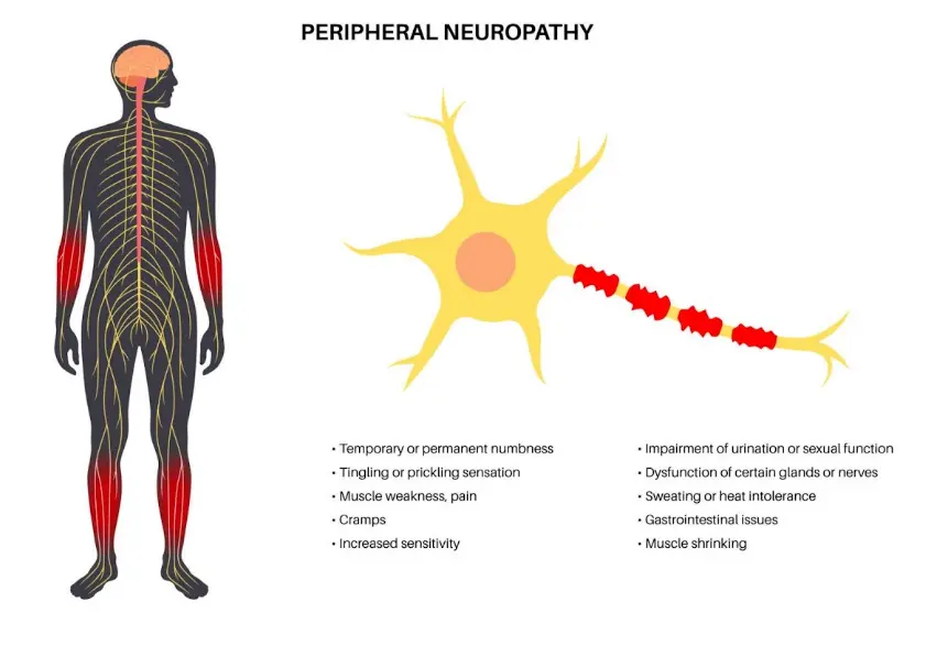 Diagram labeled Peripheral Neuropathy showing a human body silhouette with the nervous system highlighted. Red areas on the arms and legs indicate common locations where symptoms occur. Beside it, a neuron illustration shows damage along the nerve fiber. A list describes symptoms such as numbness, tingling, muscle weakness, cramps, increased sensitivity, problems with urination or glands, sweating issues, gastrointestinal problems, and muscle shrinking.