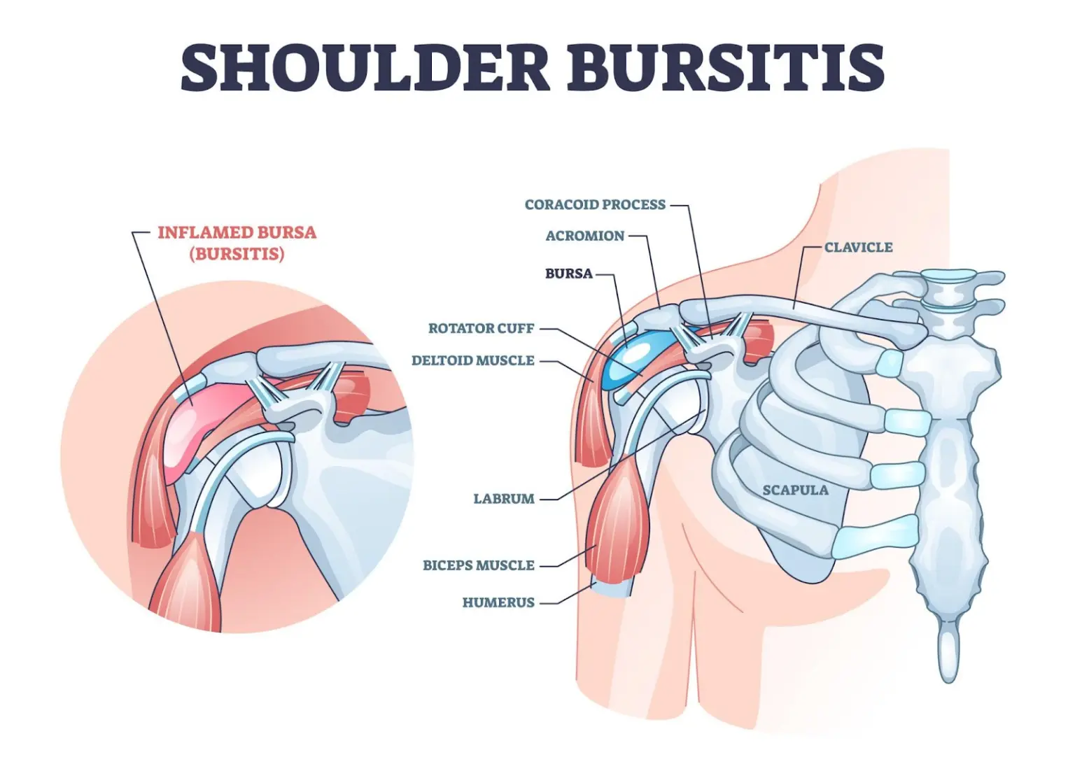 Medical illustration titled Shoulder Bursitis. The diagram shows the anatomy of the shoulder joint, including the clavicle, scapula, humerus, rotator cuff, deltoid muscle, biceps muscle, labrum, coracoid process, and acromion. A bursa sits between the rotator cuff and the acromion. A separate inset shows an inflamed bursa highlighted in red and labeled inflamed bursa (bursitis), illustrating swelling and irritation above the rotator cuff.