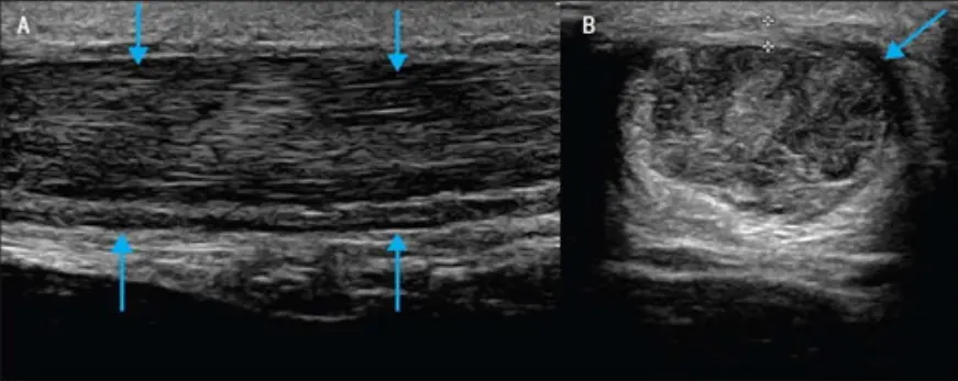 Two ultrasound images labeled A and B showing the Achilles tendon. Arrows point to areas of thickening and changes within the tendon structure. The grayscale images highlight the tendon fibers and surrounding tissue, demonstrating abnormalities associated with Achilles tendinitis.