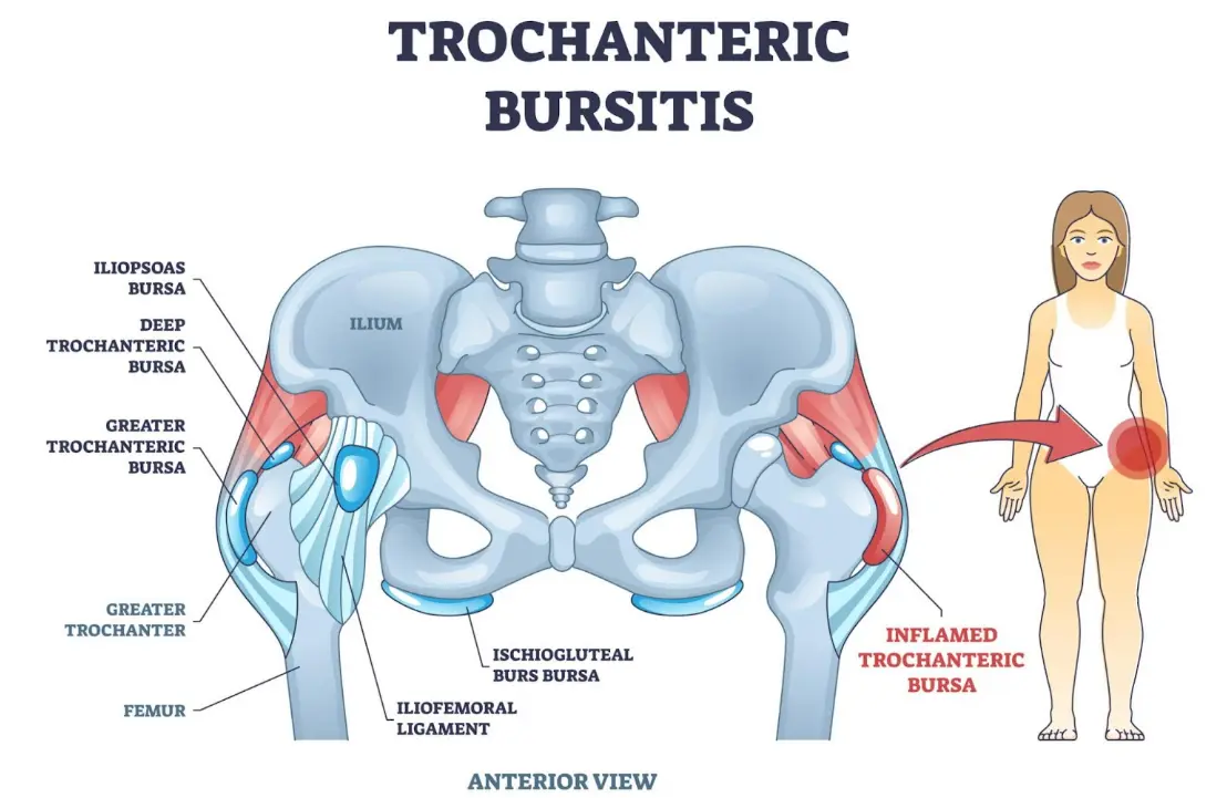 Medical illustration labeled Trochanteric Bursitis showing the pelvis and upper femur from the front. Several bursae around the hip are labeled, including the greater trochanteric bursa. A highlighted area on the outer hip indicates inflammation and the typical location of pain associated with trochanteric bursitis.