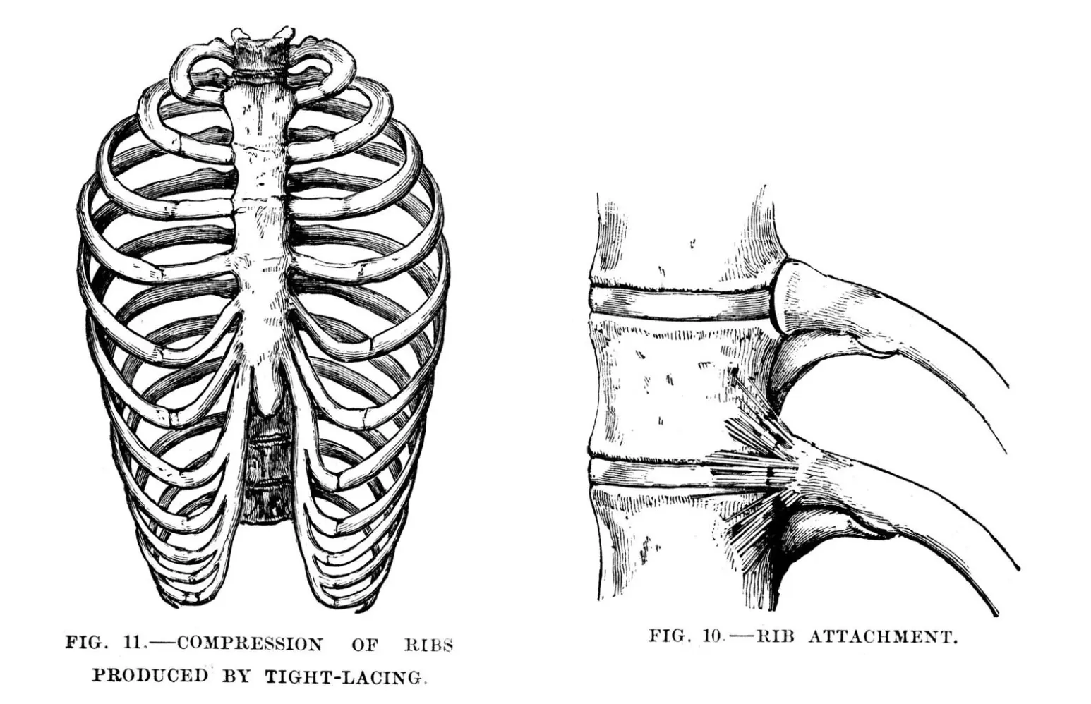 Two black-and-white anatomical engravings: Fig. 11 shows a front-view rib cage deformed by tight-lacing (corset compression), and Fig. 10 shows a close-up of rib attachment at the sternum.