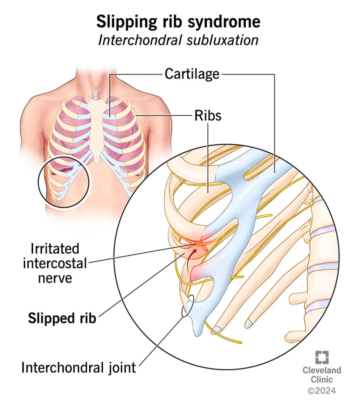 Cleveland Clinic medical diagram titled "Slipping Rib Syndrome (Interchondral Subluxation)" showing an illustration of the human rib cage with a magnified close-up of the lower rib area, labeling the cartilage, ribs, slipped rib, irritated intercostal nerve, and interchondral joint.